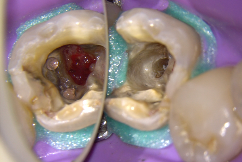 当根管再治疗遇到髓室底大穿孔