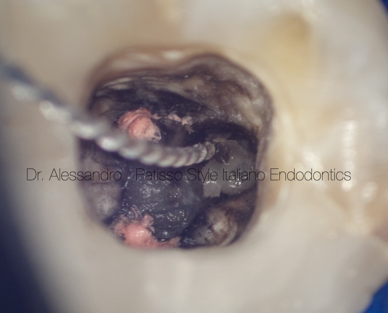 下颌第一磨牙的超声取桩再治疗