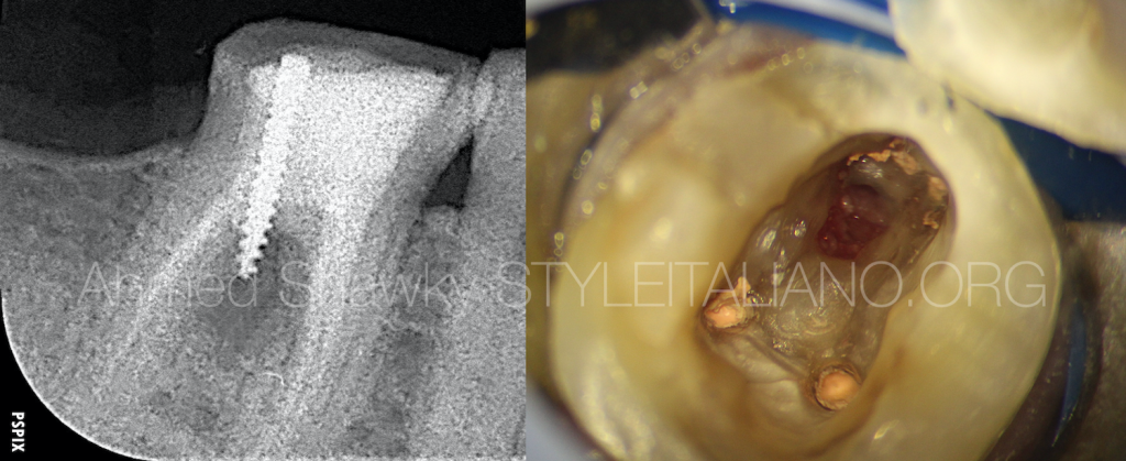 打桩致底穿的修补及根管再治疗
