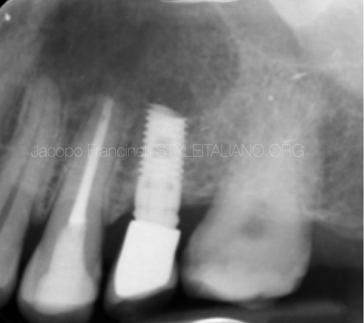 这叫......种植体根尖切除术？