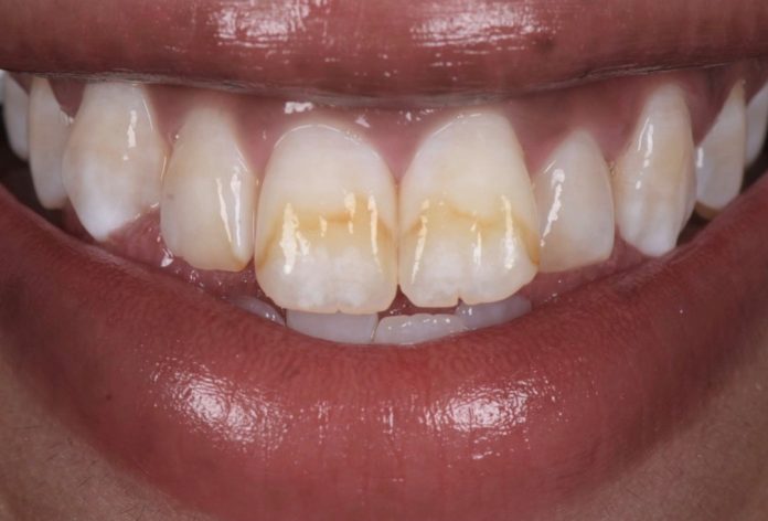 使用Icon渗透树脂和复合树脂治疗氟斑牙的保守方法