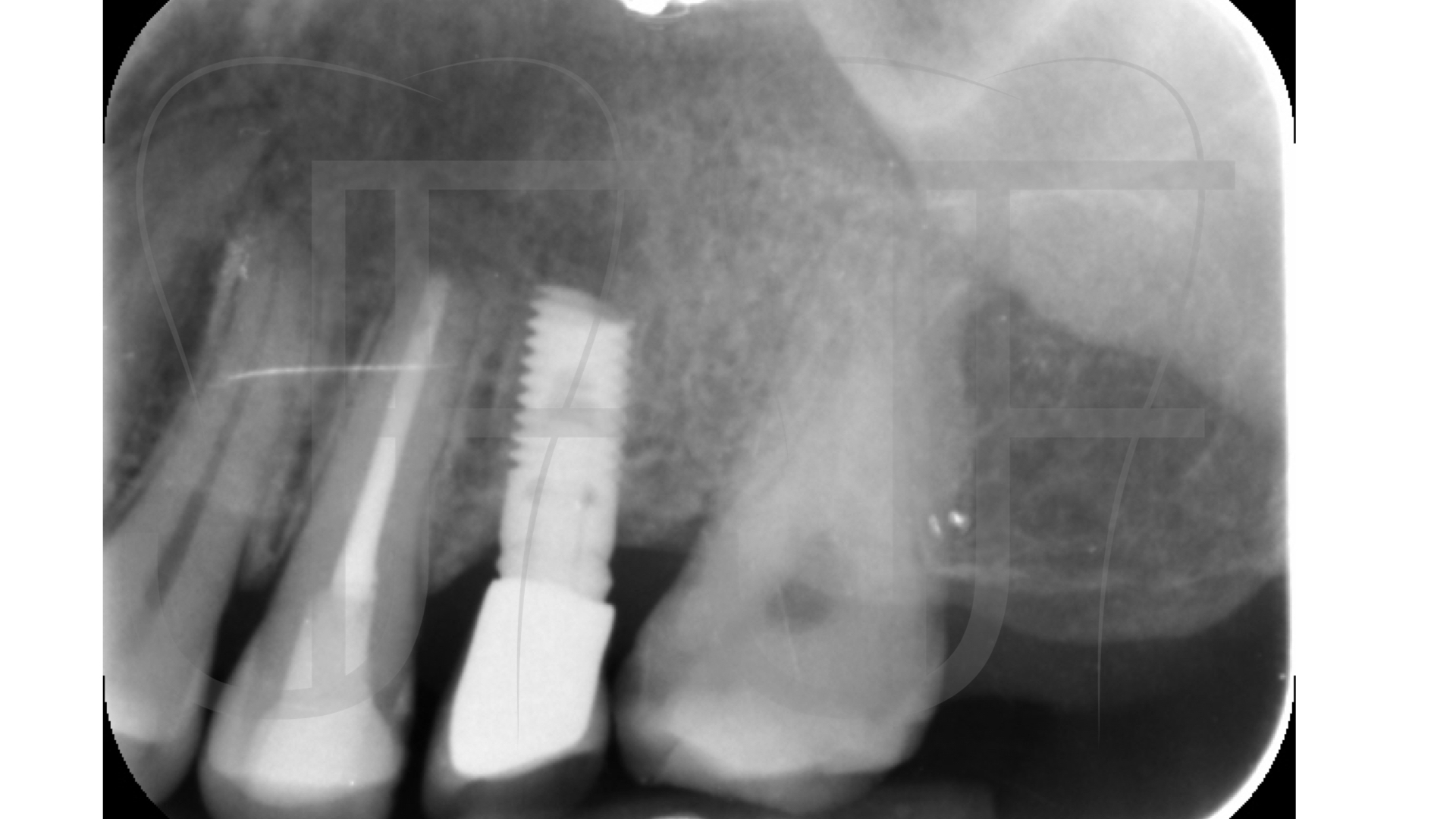 逆行性种植体周围炎-后续